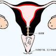 輸卵管節育術