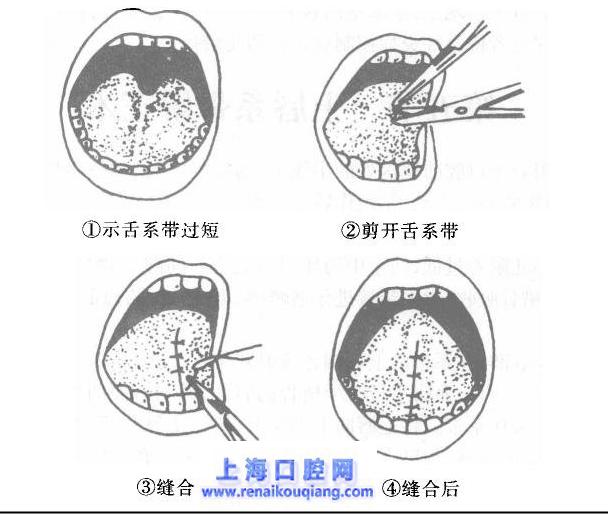 舌系帶矯正術步驟