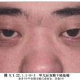 Müller肌切除術 Müller肌切除術