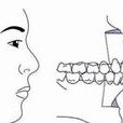牙槽突型