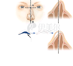 駝峰鼻及歪鼻修復術