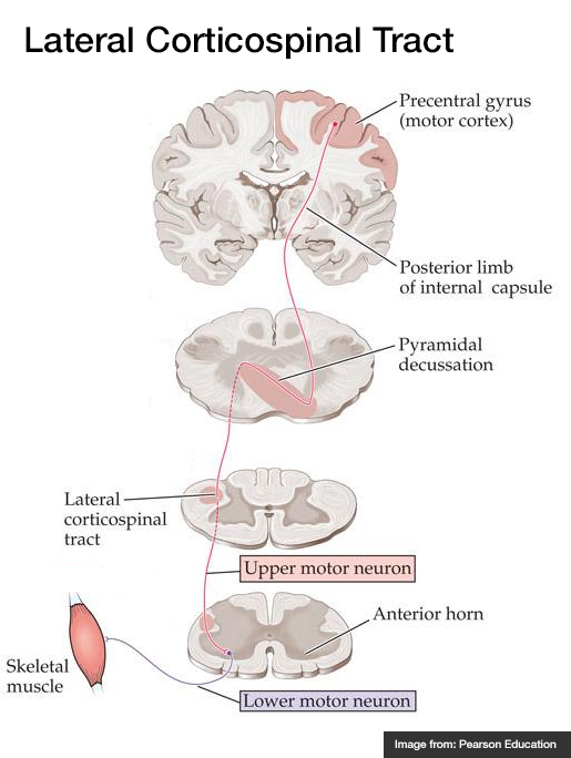 皮質脊髓側束
