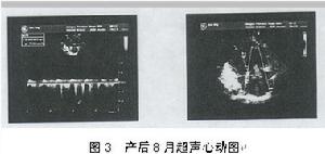 原發性肺動脈高壓