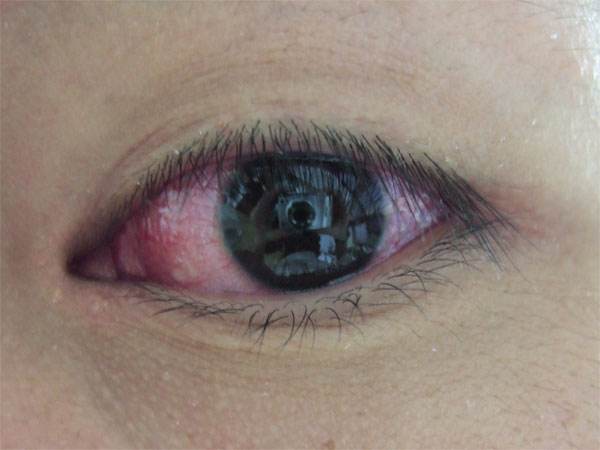 紅眼症(病症名稱)
