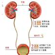 高鈣尿 高鈣尿