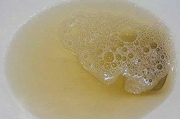 泡沫尿 泡沫尿