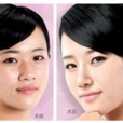 歪鼻整復術 歪鼻整復術