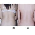 背部吸脂術 背部吸脂術