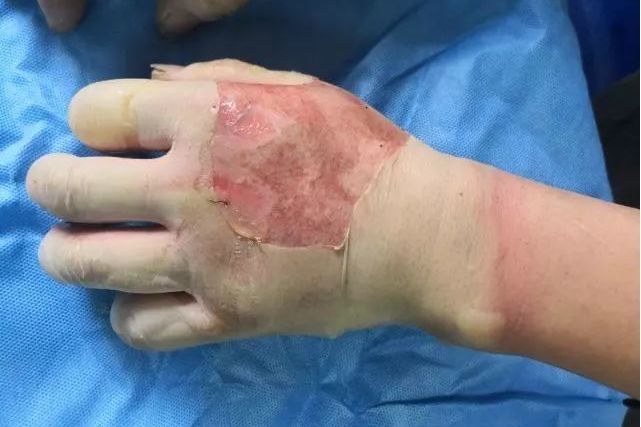 火焰燒傷 火焰燒傷