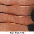 棉苗炭疽病 棉苗炭疽病