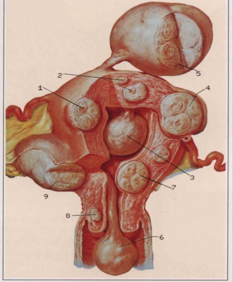 子宮肌瘤