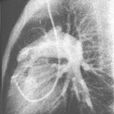 先天性肺動脈狹窄