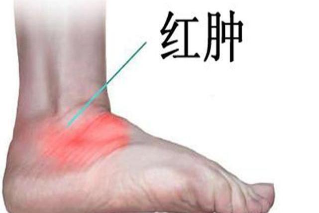 關節腫 關節腫