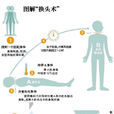 人頭移植(新型醫療技術) 人頭移植(新型醫療技術)