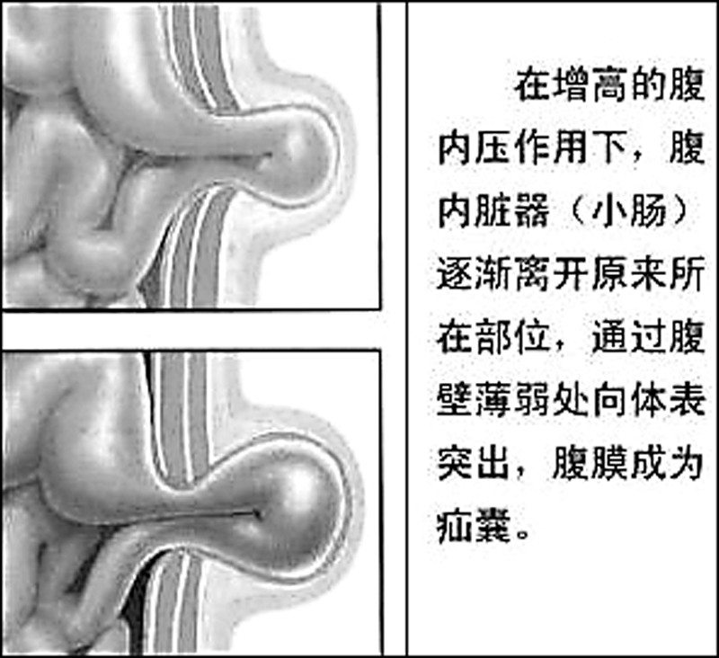 老年疝氣