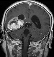 腦部CT圖片