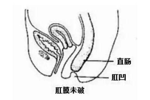 肛門凹 肛門凹