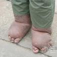 象皮腿 象皮腿