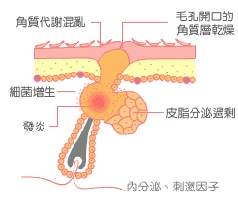 青春痘形成示意圖