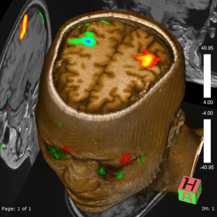 fMRI技術了解大腦活動