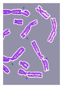 DNA損傷導致的各種損壞的染色體