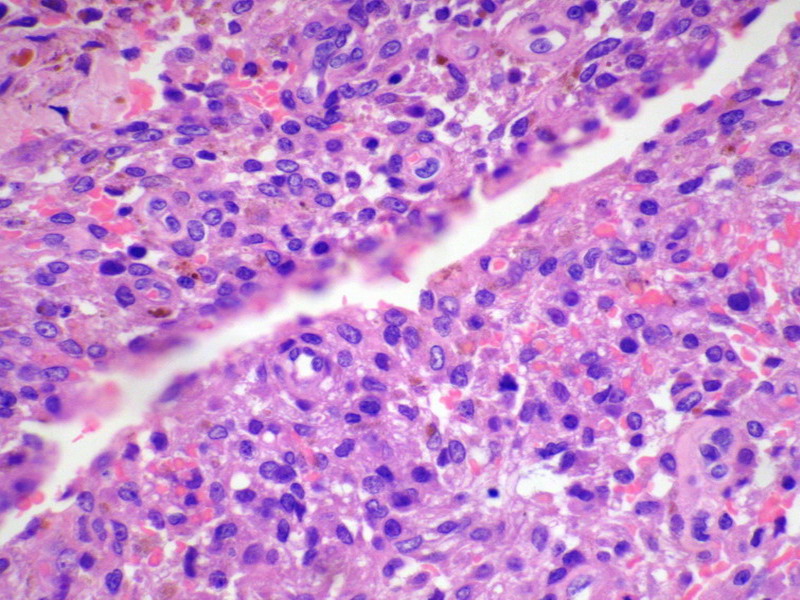 惡性組織細胞瘤