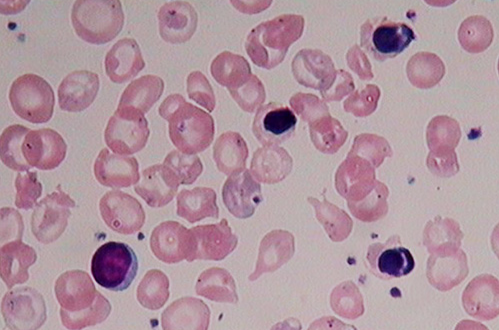血細胞分析
