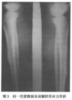 脛骨應力骨折和應力性骨膜炎