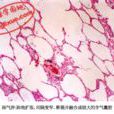 水性肺氣腫 水性肺氣腫