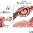 宮外孕流產