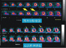 99mTc-MIBI心肌血流灌注顯像