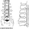 脊柱骨折脫位合併截癱手術