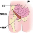 小腸疝氣 小腸疝氣