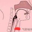 喉頭髮緊 喉頭髮緊