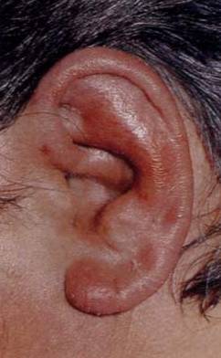 耳廓軟骨膜炎