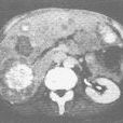 轉移性肝腫瘤