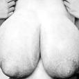 乳腺肥大 乳腺肥大