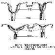 環狀胎盤