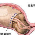 分娩併發症 分娩併發症