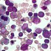 慢性粒單核細胞白血病