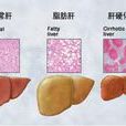 頑固性肝腹水 頑固性肝腹水