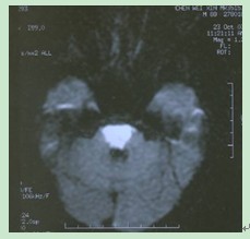 腦幹梗死MRI表現：DWI相