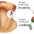 淋巴ca 淋巴ca