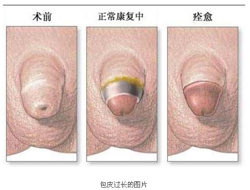 韓式包皮環切手術