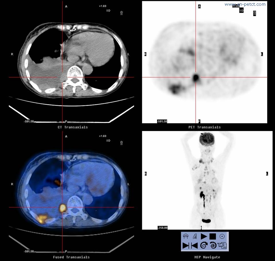浸潤型肺結核CT檢查