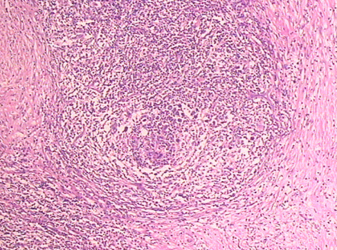B淋巴細胞