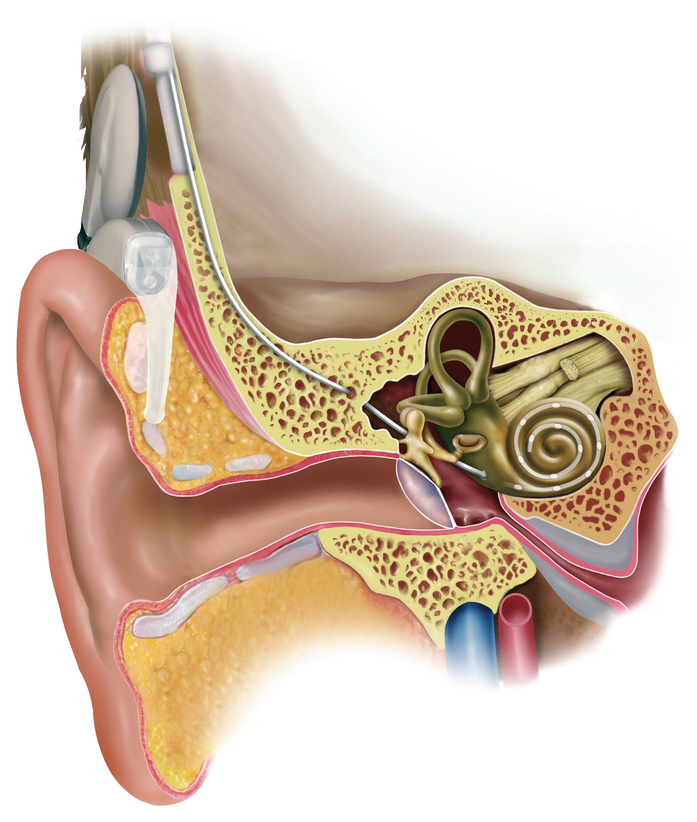 電子耳蝸植入圖