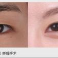 切雙眼皮 切雙眼皮