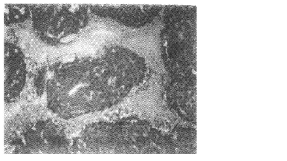 大鼠肝癌細胞注入蓖麻毒蛋白後病理切片
