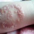 皮膚病真菌 皮膚病真菌